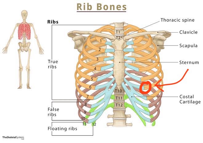Model Broken Rib A Fractured Rib (32 of 100) – Juan David